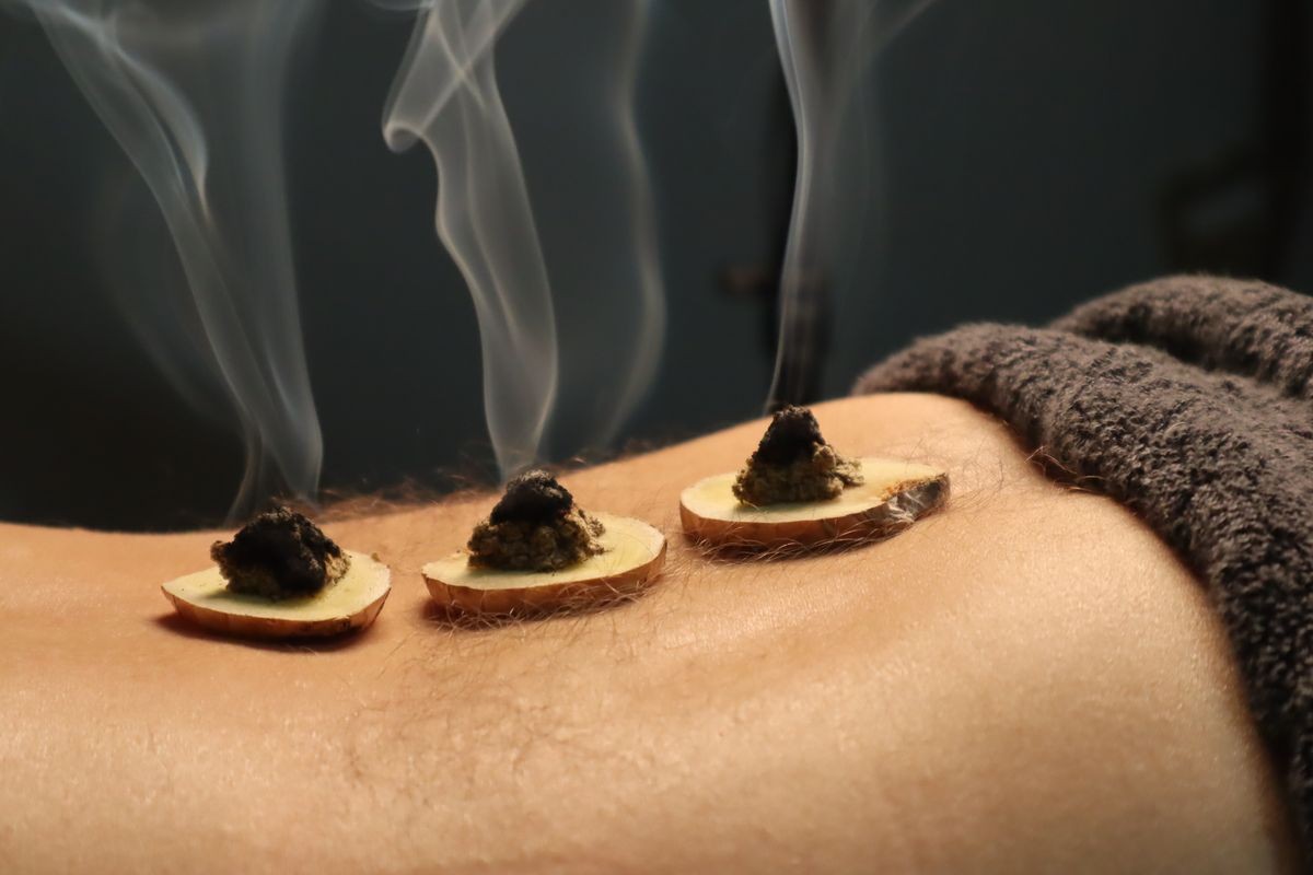 Moxa cones on ginger slices during moxibustion